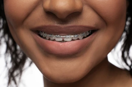 Modern braces treatment
