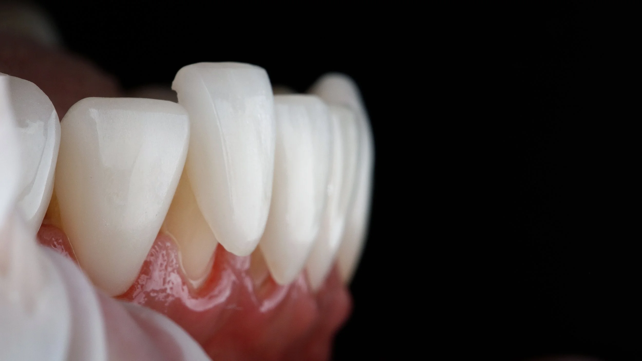 Porcelain veneers smile design